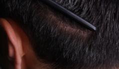 Before Hair Transplant&nbsp;Front